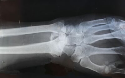 What Breaking your hand teaches you about ‘Going Digital’